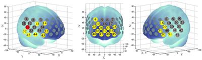 A Decrease in Hemodynamic Response in the Right Postcentral Cortex Is Associated With Treatment-Resistant Auditory Verbal Hallucinations in Schizophrenia: An NIRS Study